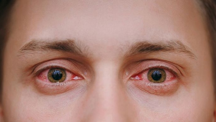 Phương pháp phòng tránh bệnh đau mắt đỏ